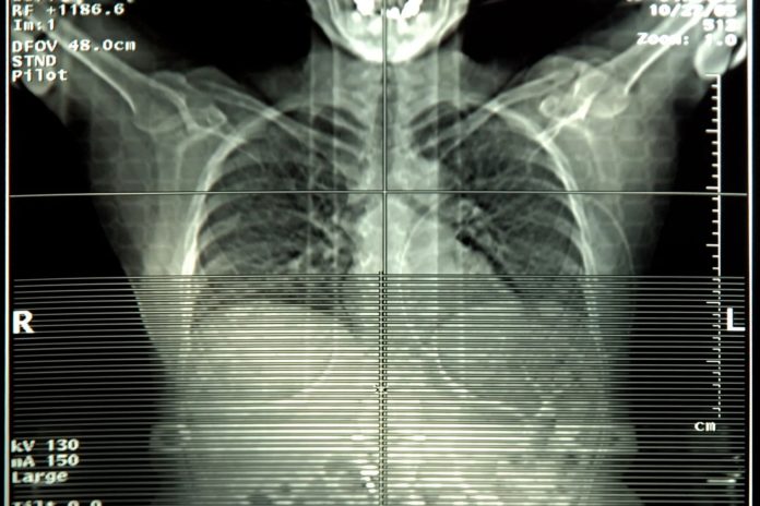 surgery-beats-targeted-radiation-for-early-stage-lung-cancer