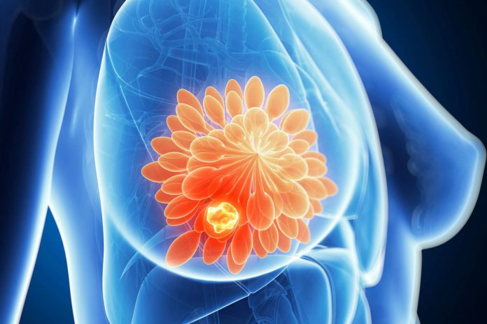 some-breast-cancer-patients-may-safely-forgo-chemotherapy