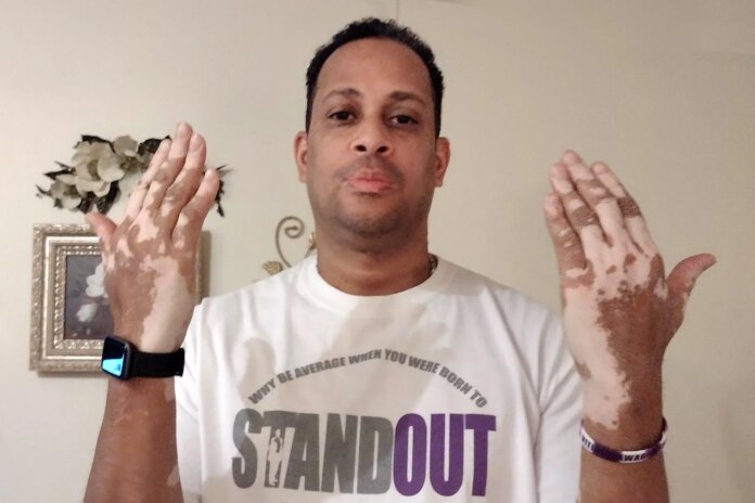 vitiligo:-my-life-with-this-skin-condition