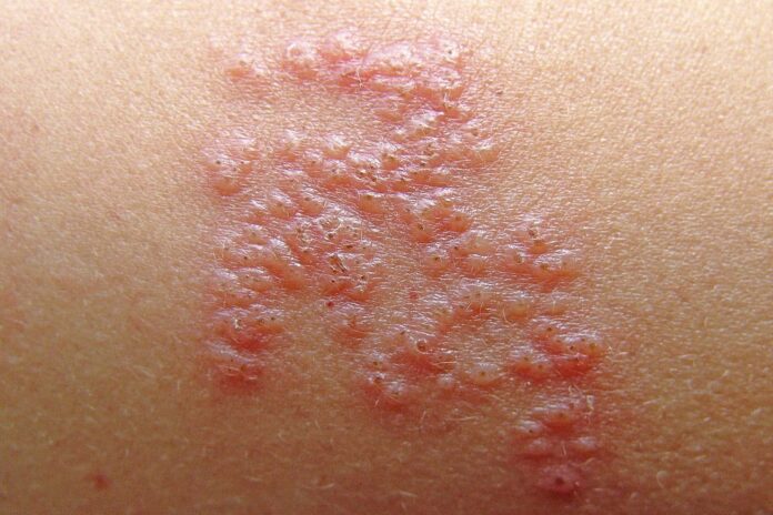 pandemic-and-costs-limited-use-of-shingles-vaccine