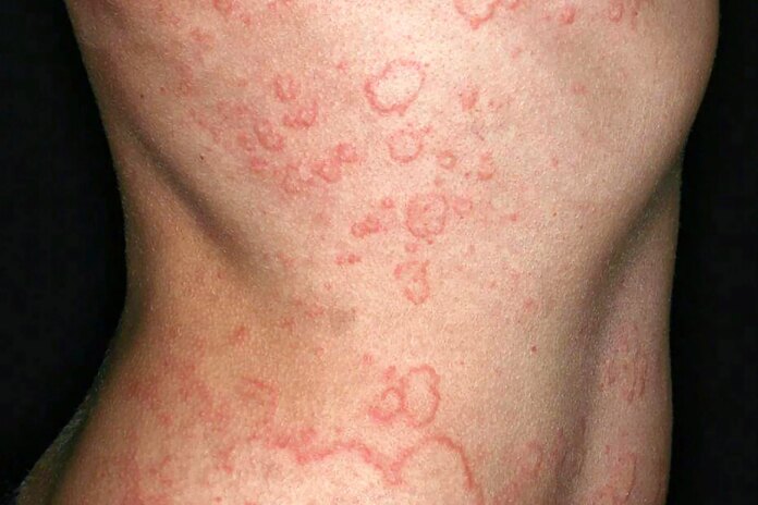 chronic-spontaneous-urticaria:-what-to-know